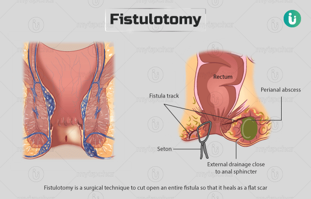 नालव्रणछेदन (फिस्टुलोटमी) - Fistulotomy in Hindi