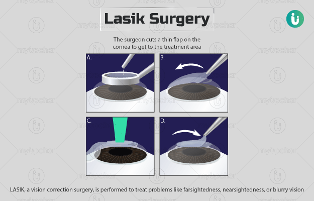 लेसिक लेजर सर्जरी - Lasik surgery in Hindi