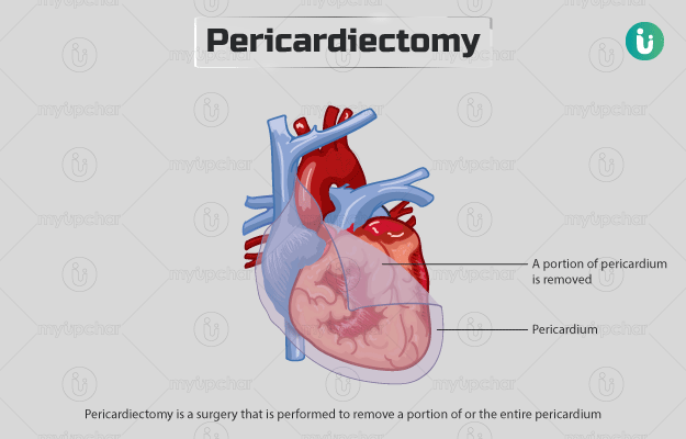 पेरिकार्डेक्टमी - Pericardiectomy in Hindi