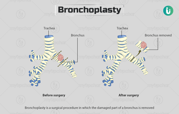 ब्रोन्कोप्लास्टी - Bronchoplasty in Hindi