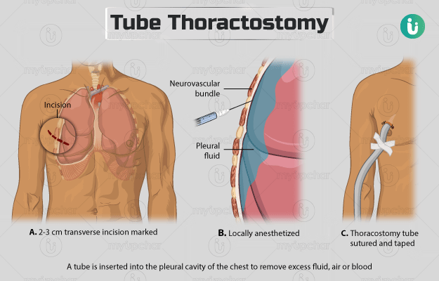 ट्यूब थोराकोस्टोमी - Tube thoracostomy in Hindi