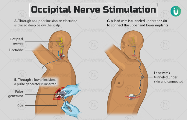 Occipital Nerve Stimulation