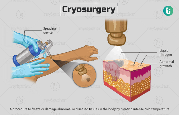 क्रायोसर्जरी - Cryosurgery in Hindi