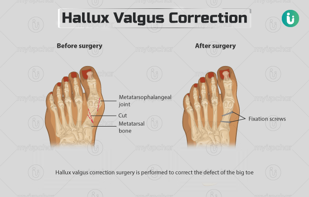 हैलक्स वैल्गस करेक्शन सर्जरी - Hallux valgus correction in Hindi