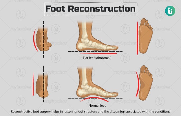 फुट रिकंस्ट्रक्शन - Foot reconstruction in Hindi