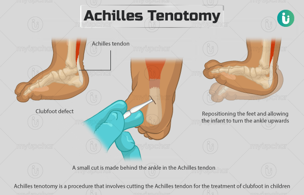 Achilles tenotomy