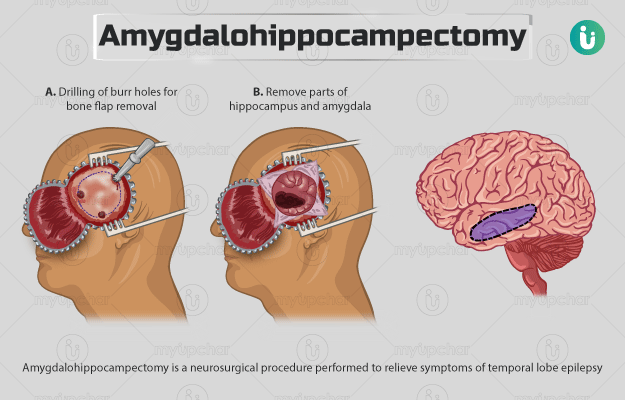 एमिग्डलोहिप्पोकैम्पेक्टमी - Amygdalohippocampectomy in Hindi