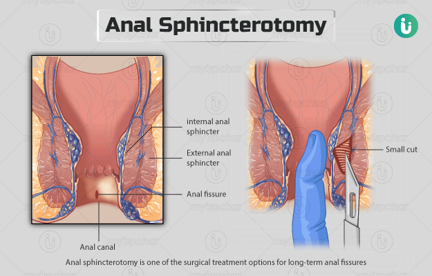 स्फिंक्टेरोटोमी/ऐनल स्फिंक्टेरोटोमी - Sphincterotomy/anal sphincterotomy in Hindi