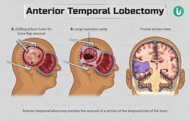ऐन्टिरीयर टेम्पोरल लोबेक्टोमी - Anterior temporal lobectomy in Hindi
