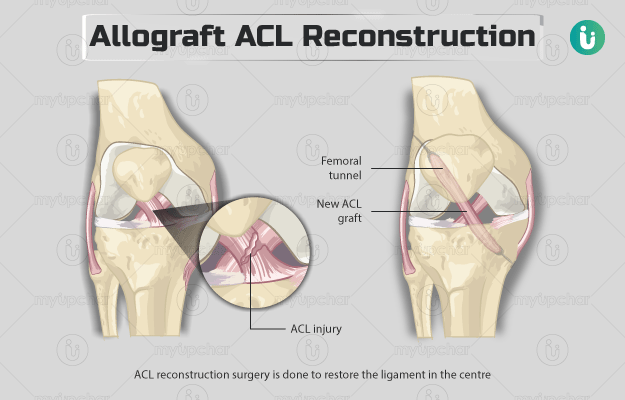 एलोग्राफ्ट एसीएल रिकंस्‍ट्रक्‍शन - Allograft acl reconstruction in hindi
