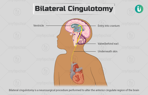 Bilateral cingulotomy