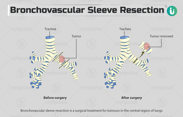 ब्रोन्कोवस्कुलर स्लीव रिसेक्शन - Bronchovascular Sleeve Resection in Hindi