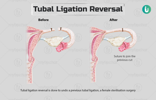 ट्यूबल लिगेशन रिवर्सल - Tubal ligation reversal in Hindi