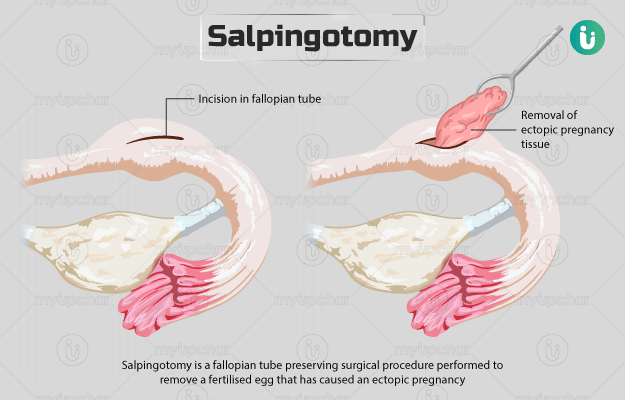 साल्पिंगोटॉमी - Salpingotomy in Hindi
