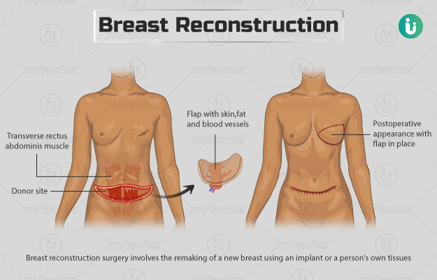 ब्रेस्ट रिकंस्ट्रक्शन सर्जरी - Breast reconstruction in Hindi