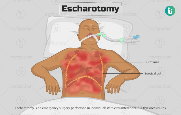 एस्केरोटॉमी - Escharotomy in Hindi
