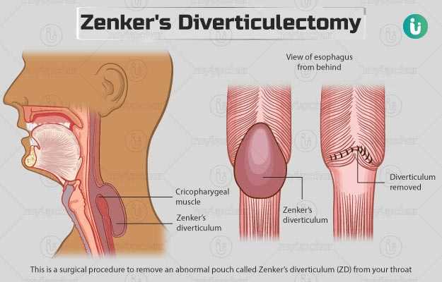 जेनकर डायवर्टिकुलेक्टॉमी - Zenker's Diverticulectomy in Hindi