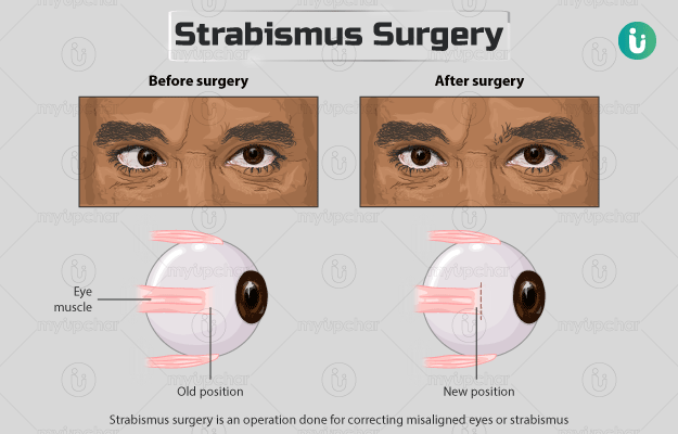 भेंगेपन की सर्जरी - Strabismus surgery in Hindi