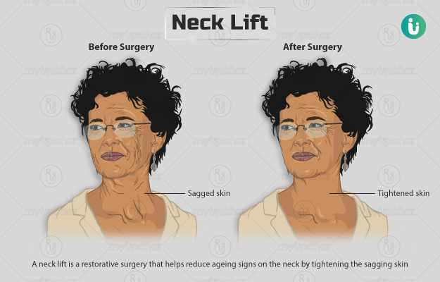नेक लिफ्ट सर्जरी (गर्दन से अतिरिक्त त्वचा और वसा को निकालने के लिए सर्जरी) - Neck Lift in Hindi