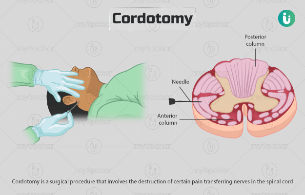 कॉर्डोटमी - Cordotomy in Hindi