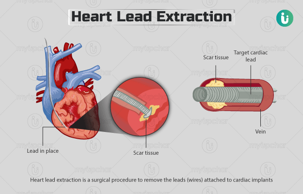 Heart lead extraction