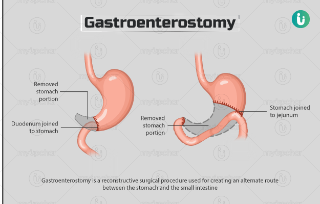Gastroenterostomy