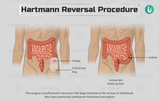 हार्टमैन रिवर्सल प्रोसीजर - Hartmann Reversal Procedure in Hindi