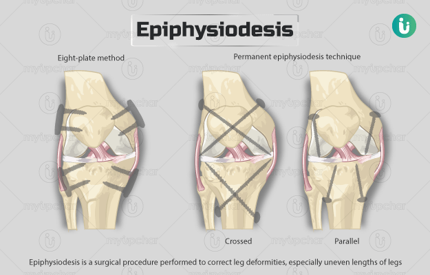 एपिफिसिओडेसिस - Epiphysiodesis surgery in Hindi