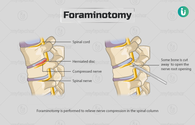 फोरमीनोटमी - Foraminotomy in Hindi