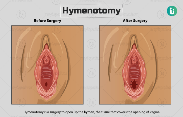 हाइमेनोटॉमी - Hymenotomy in Hindi