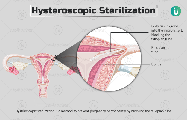 हिस्टेरोस्कोपिक स्टरलाइजेशन - Hysteroscopic Sterilization in Hindi