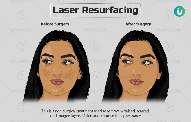 लेजर स्किन रिसर्फेसिंग - Laser Skin Resurfacing in Hindi
