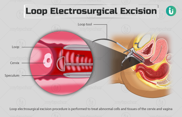 लूप इलेक्ट्रोसर्जिकल एक्सिशन प्रोसीजर (एलईईपी) - Loop electrosurgical excision procedure (LEEP) in Hindi