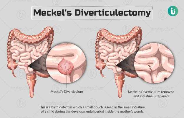मेक्केल डायवर्टीकुलेक्टॉमी - Meckel's Diverticulectomy in Hindi