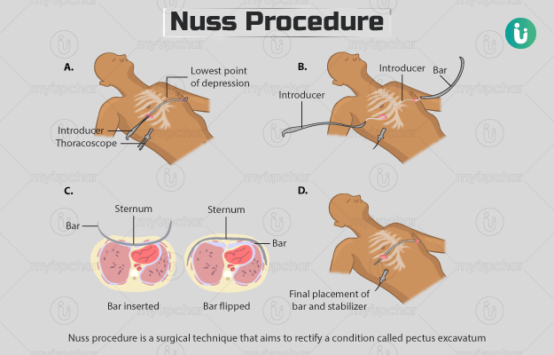 नस्स प्रोसीजर - Nuss procedure in Hindi