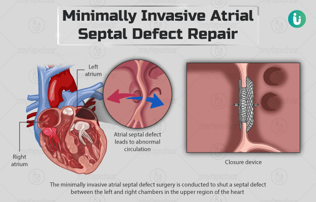 Minimally invasive atrial septal defect repair