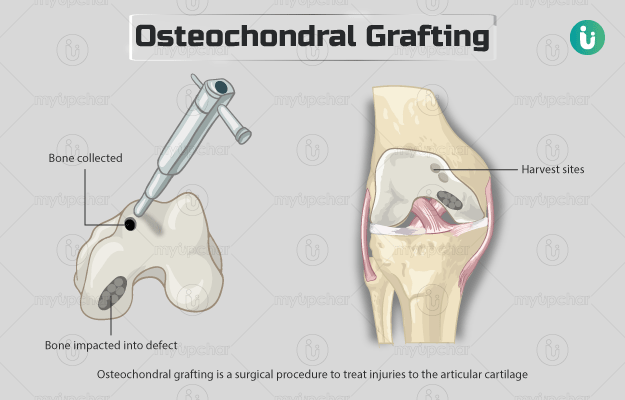 Osteochondral Grafting