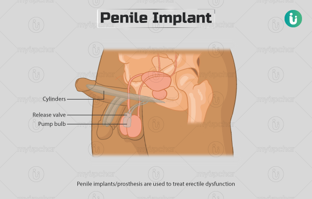 पेनाइल इम्प्लांट सर्जरी - Penile Implant in Hindi