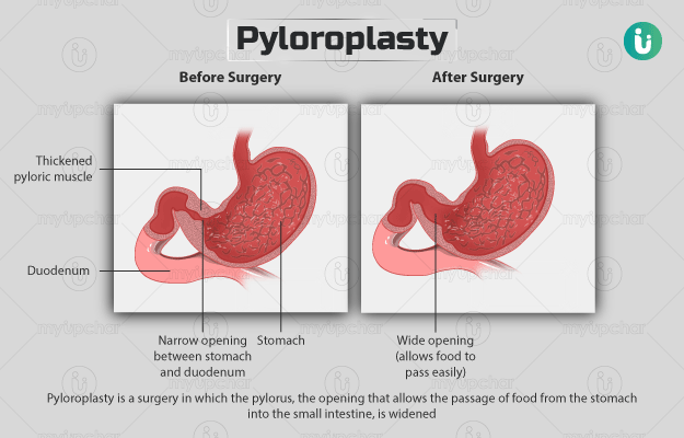 पाइलोरोप्लास्टी - Pyloroplasty in Hindi