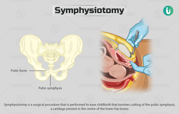 सिम्फिसियोटमी - Symphysiotomy in Hindi