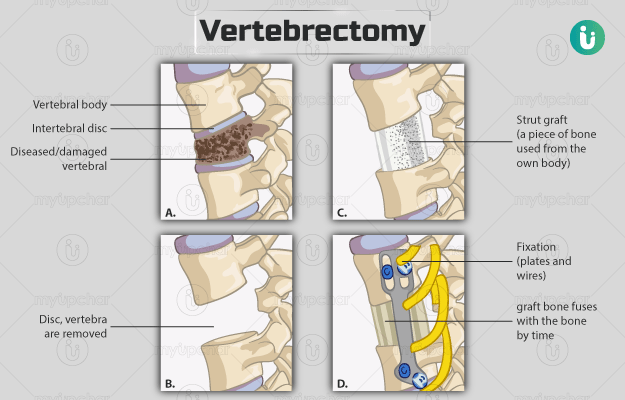 Vertebrectomy