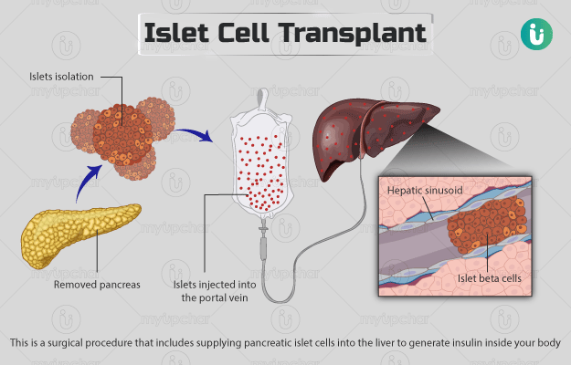 Islet cell transplant