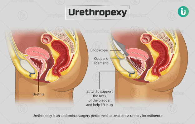 Urethropexy