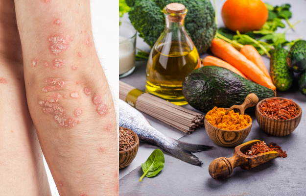 Psoriasis diet: food to eat and avoid