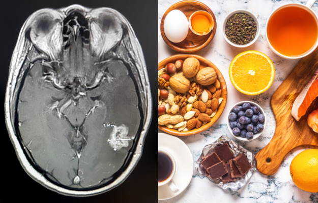 Brain tumour diet: food to eat and avoid