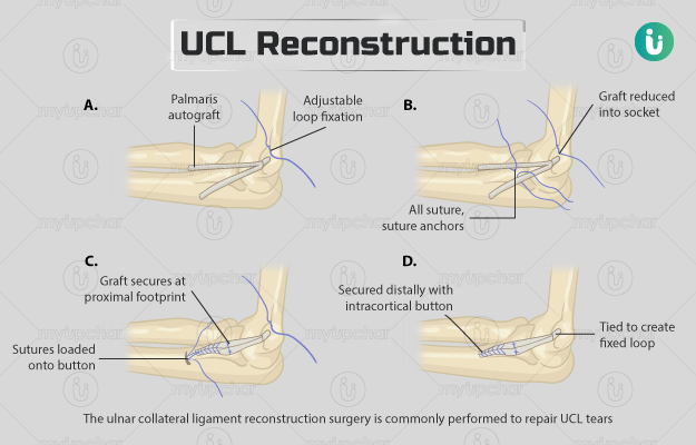UCL reconstruction