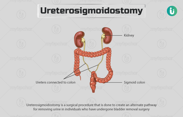Ureterosigmoidostomy