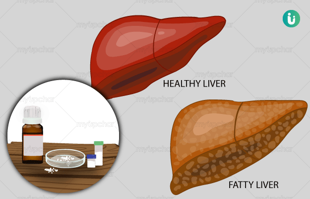 फैटी लीवर की होम्योपैथिक दवा और इलाज - Homeopathic medicine and treatment for Fatty Liver in Hindi