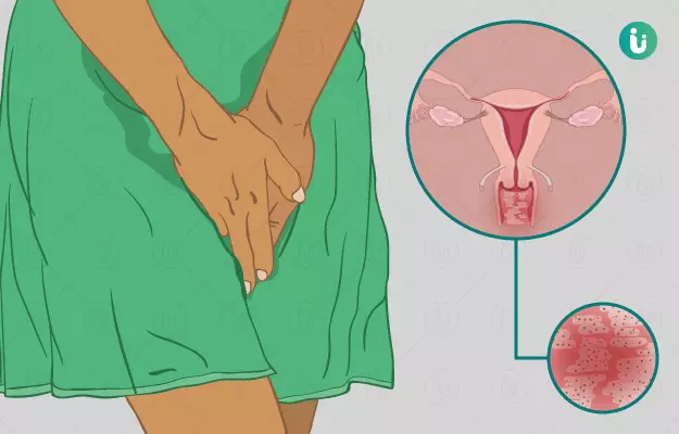 योनि में जलन के कारण, इलाज और उपाय - Vaginal burning causes and treatment in Hindi
