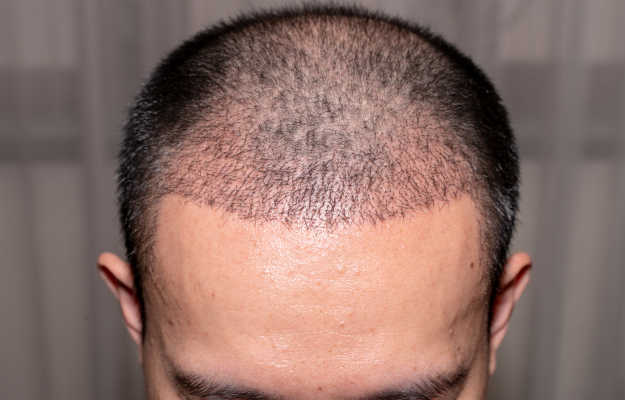 Is hair regrowth possible?